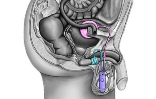 Schließmuskelprothese AMS 800 - Künstlicher Schließmuskel